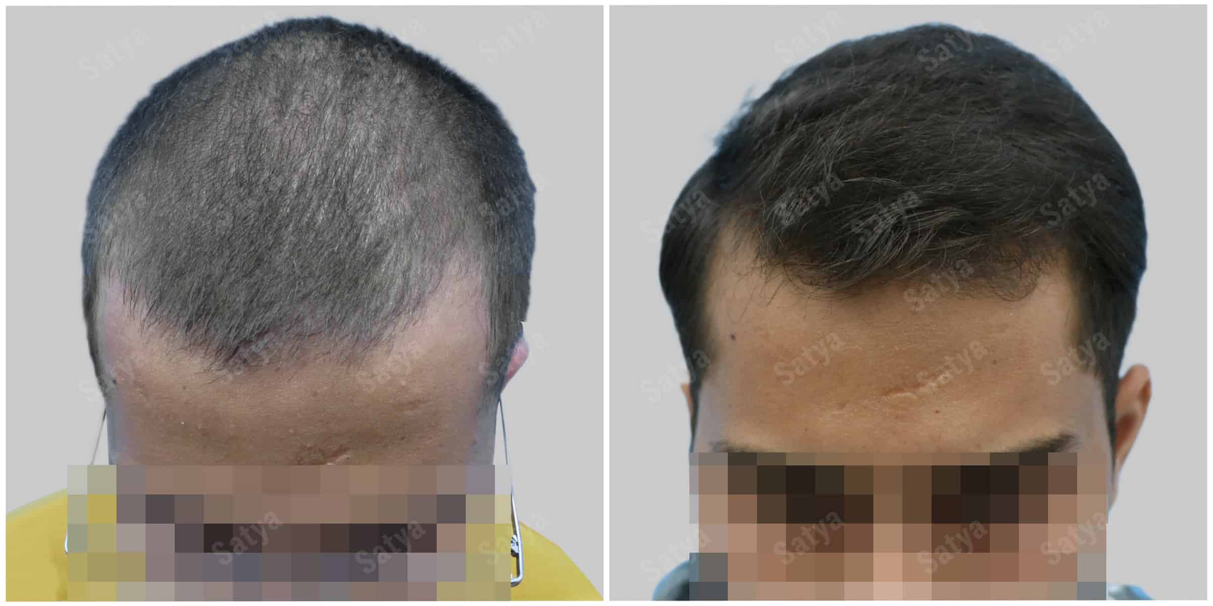 repair hair transplant