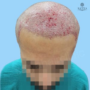 synthetic hair implant