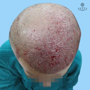 synthetic hair implant