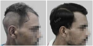 synthetic hair transplant