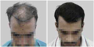 synthetic hair transplant