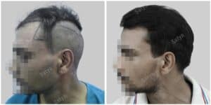 synthetic hair transplant