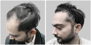 repair hair transplant