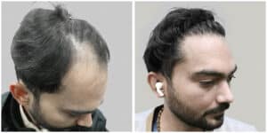 repair hair transplant