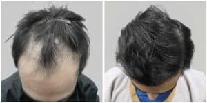 repair hair transplant