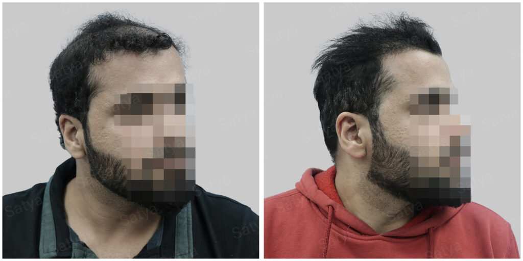 synthetic hair implant in delhi