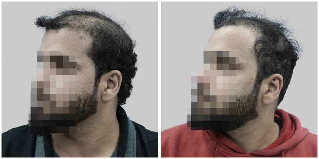 synthetic hair implant in delhi