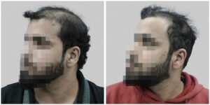 synthetic hair implant in delhi