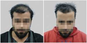 synthetic hair implant in delhi