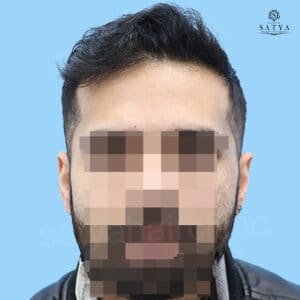 synthetic hair implant