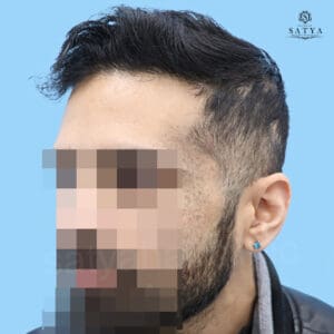 synthetic hair implant