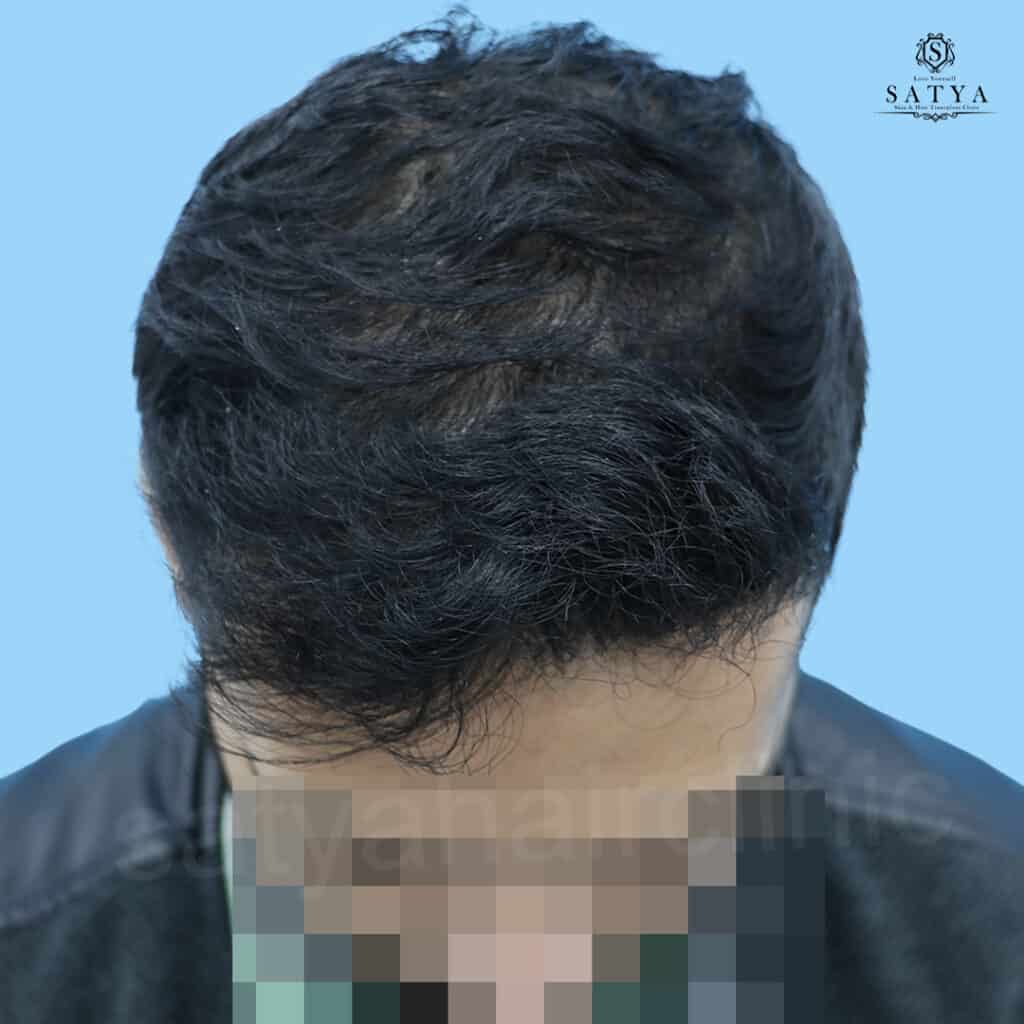 synthetic hair implant