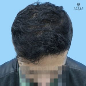 synthetic hair implant