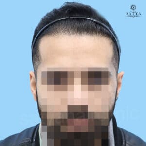 synthetic hair implant