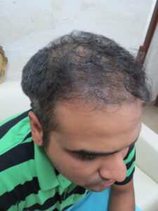 wrong hair transplant
