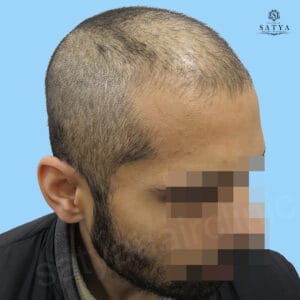 synthetic hair implant