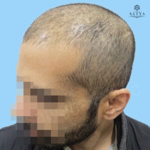 synthetic hair implant