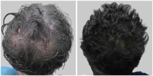 repair hair transplant