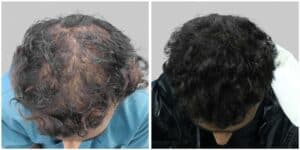 repair hair transplant