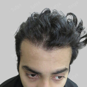 synthetic hair transplant