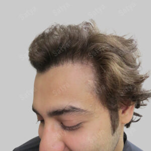 synthetic hair transplant