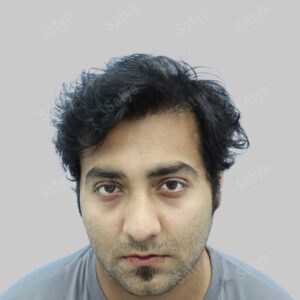 synthetic hair transplant