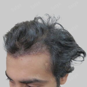 synthetic hair transplant