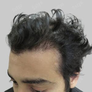 synthetic hair transplant