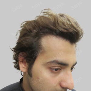 synthetic hair transplant