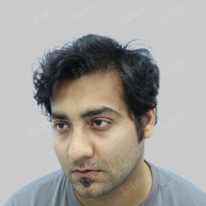 synthetic hair transplant