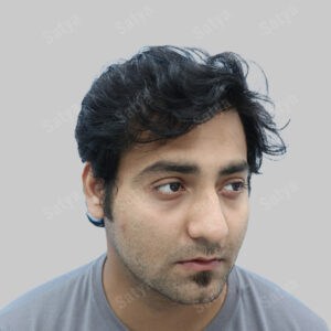 synthetic hair transplant