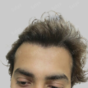 synthetic hair transplant