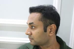 synthetic hair implant