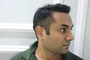 synthetic hair implant