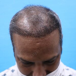 hair restoration