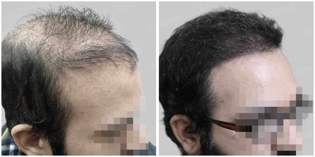 synthetic hair implant