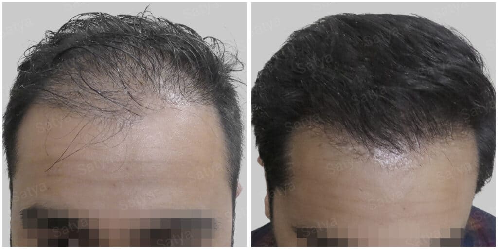 artificial hair transplant
