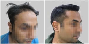 best hair transplant