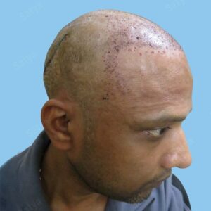 synthetic hair transplant