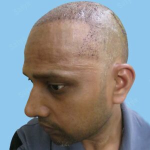 synthetic hair transplant