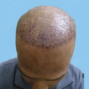 synthetic hair transplant
