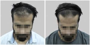 synthetic hair implant