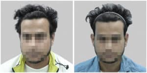 synthetic hair implant