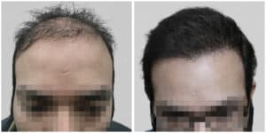 synthetic hair implant