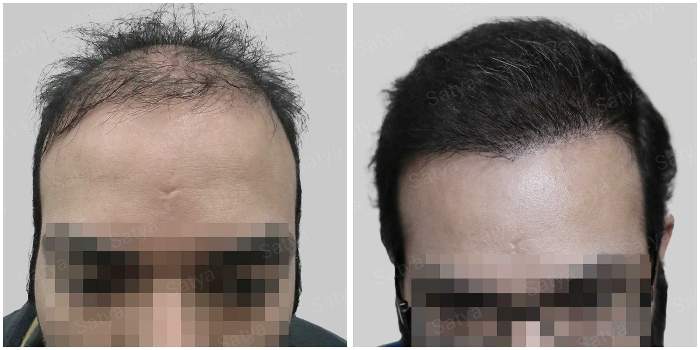 synthetic hair implant