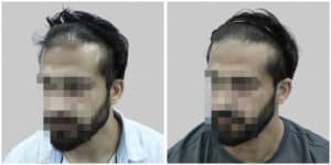 synthetic hair implant