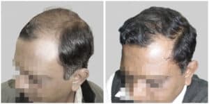 synthetic hair implant