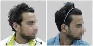 synthetic hair implant