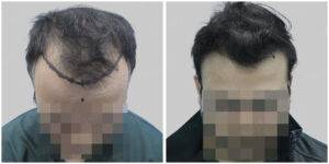 hair transplant result