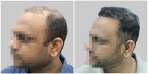 synthetic hair implant